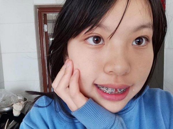 戴牙套吸電子煙嗎