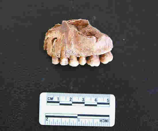 牙周病、根尖膿腫、牙結石