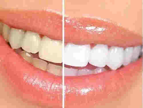 悅刻電子煙會讓牙齒變黃嗎？