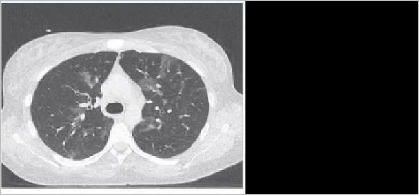 抽電子煙抽出肺泡(悅刻電子煙抽出肺泡)